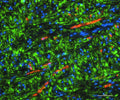 Remyelinated lesion of index case stained for PLP (green) and Pzero (Cat. PZO, red), showing that the myelin is distinctly from oligodendrocyte or Schwann cell origin, respectively. Image courtesy of Bryan Bollman, Washington