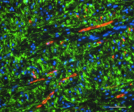 Remyelinated lesion of index case stained for PLP (green) and Pzero (Cat No. PZO, red), showing that the myelin is distinctly from oligodendrocyte or Schwann cell origin, respectively. Image courtesy of Bryan Bollman, Washington University in St. Louis.