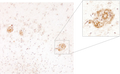 Beta-Amyloid-positive “neuritic plaque” (shown in higher magnification) in cerebral cortex as seen in a post-mortum specimen taken from an Alzheimer’s disease patient. Picture courtesy of Dr. Randy Woltjer, Oregon Health & Sciences University.