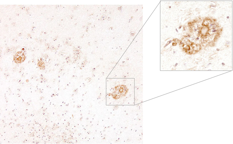 Beta-Amyloid-positive “neuritic plaque” (shown in higher magnification) in cerebral cortex as seen in a post-mortum specimen taken from an Alzheimer’s disease patient. Picture courtesy of Dr. Randy Woltjer, Oregon Health & Sciences University.