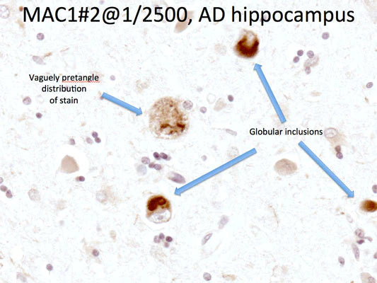 Frame showing MAC-1 immunoreactivity in human microglial cells in an Alzheimer's Disease patient. Photomicrograph taken by Dr. Randy Woltjer, Pathology, OHSU.