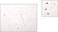 Immunohistochemical presence of tau in neurofibrillary tangles in cortical neurons of an Alzheimer's Disease patient. Anti-Tau antibody (1:10,000) was incubated with formalin-fixed, paraffin-embedded sectioned material from Alzheimer's brains. Primary antibody was visualized with HRP-labeled goat anti-chicken IgY. Dr. Randy Woltjer, Oregon Health & Sciences University.