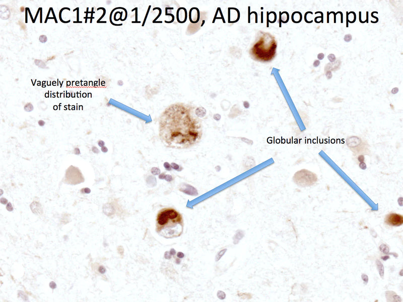 Frame showing MAC-1 immunoreactivity in human microglial cells in an Alzheimer's Disease patient. Photomicrograph taken by Dr. Randy Woltjer, Pathology, OHSU.